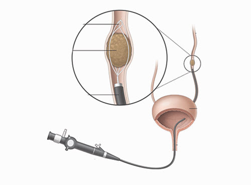 سنگ شكني از طريق مجاري ادرار
